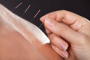 New rules for acupuncture licensure in texas